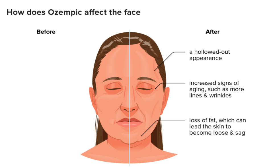 ozempic face